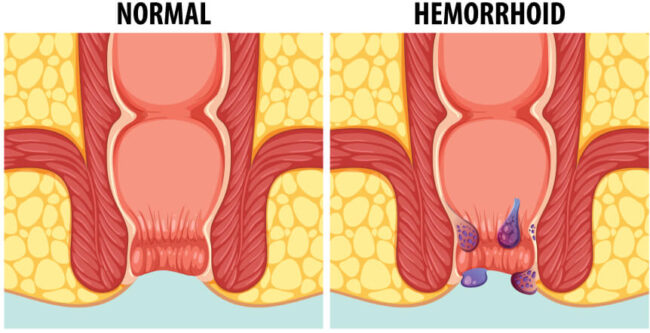 Natural Remedies for Hemorrhoids 